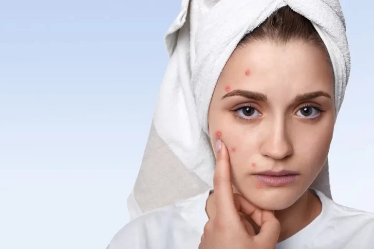 4 Different Acne Types, Its Causes, Prevention & Treatment